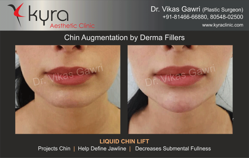 Chin Augmentation Cosmetic Surgery In Ludhiana Plastic Surgery In